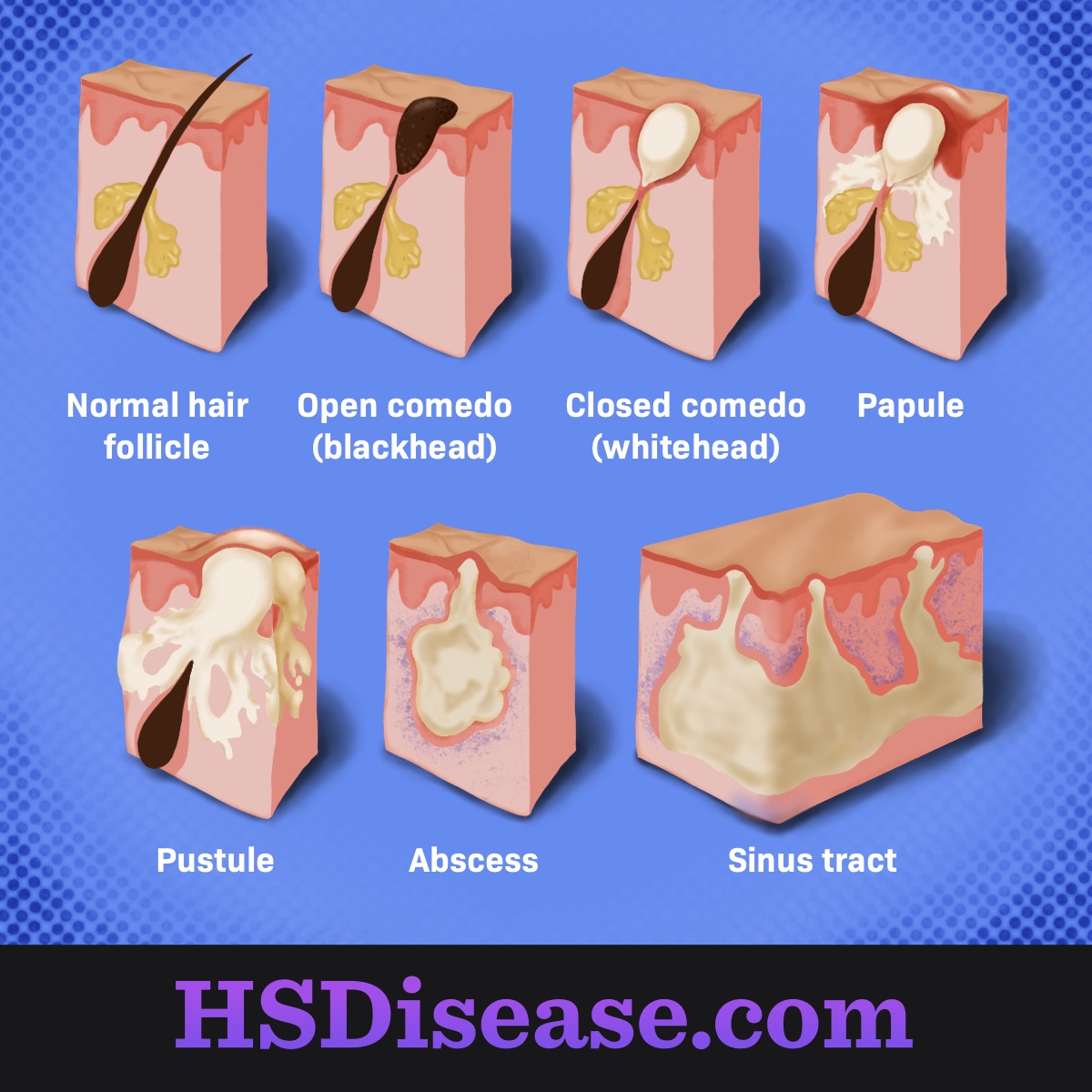 Hidradenitis Suppurativa Symptoms: Bumps