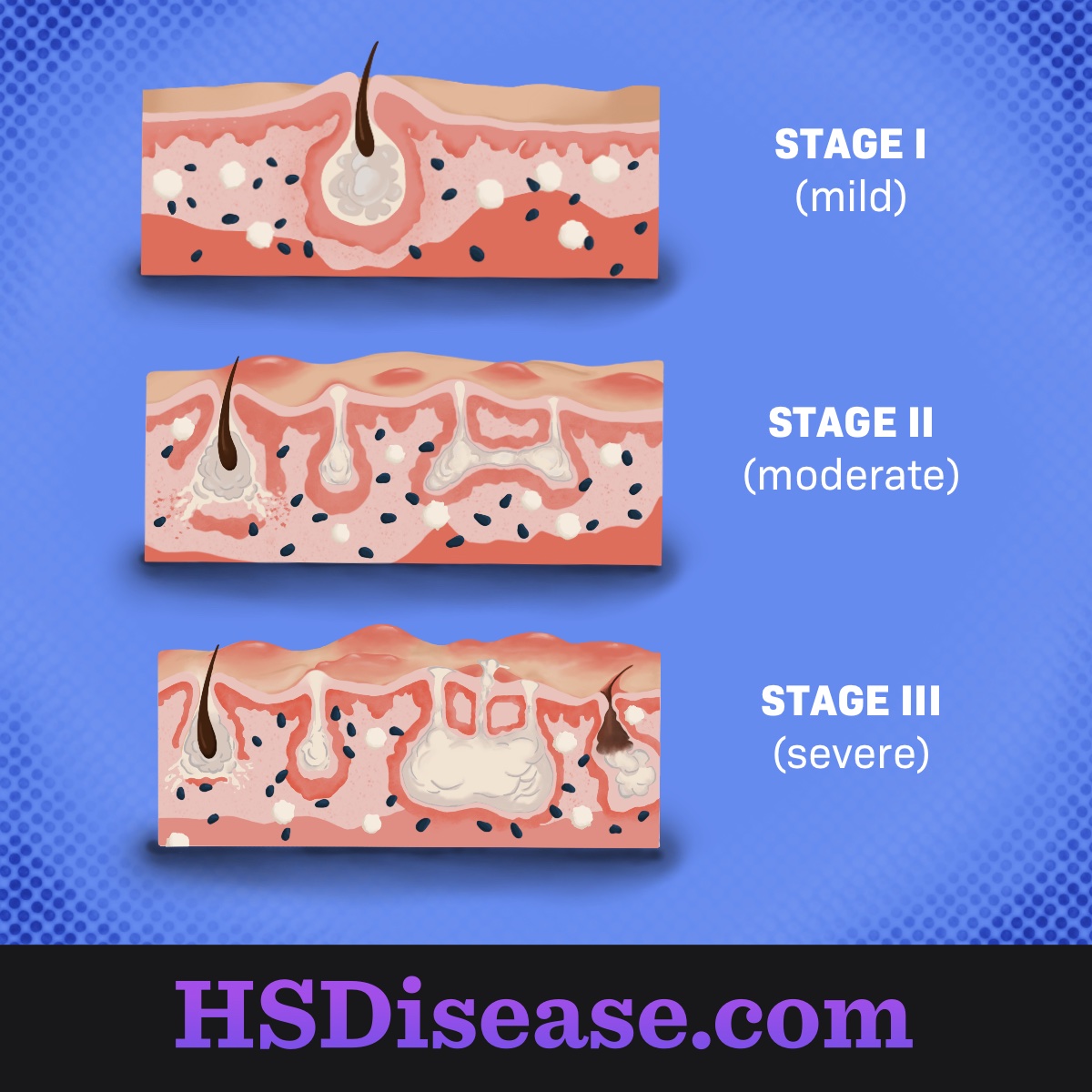 How To Describe Hidradenitis Suppurativa On Physical Exam