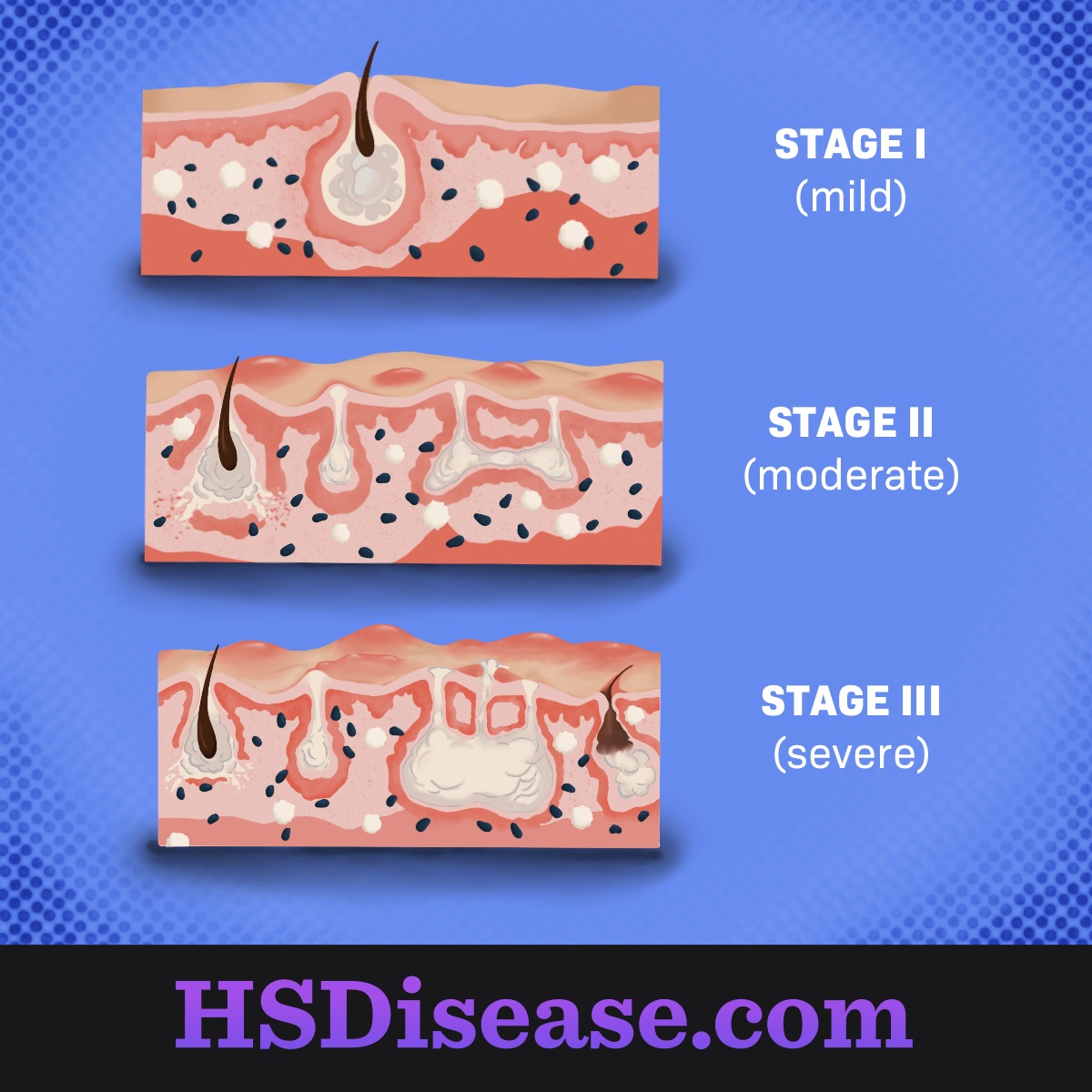 Hidradenitis Suppurativa Diagnosis Physical Examination