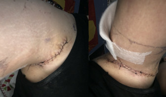 Selina's armpit after her second surgery.