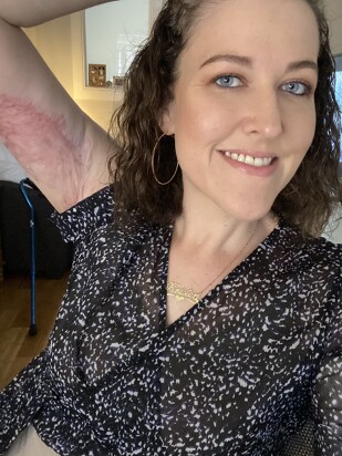 Kristen with hidradenitis suppurativa scars