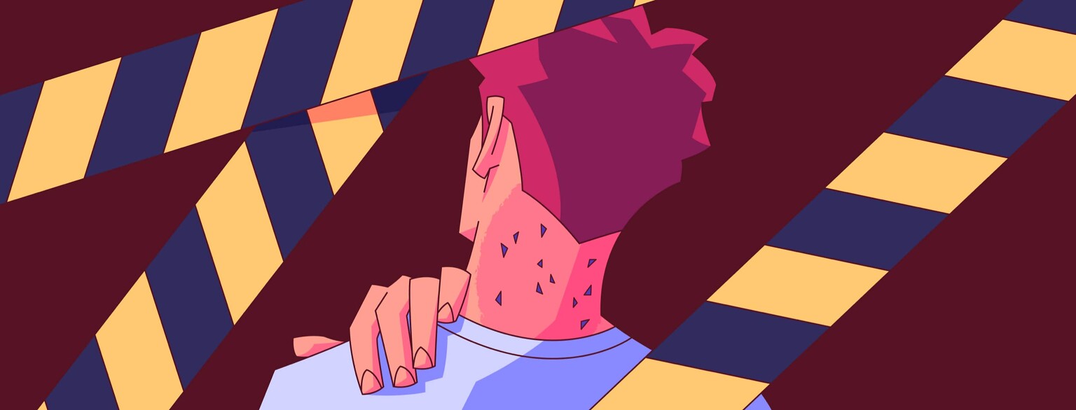 A Guide to Managing Hidradenitis Suppurativa Blackheads image