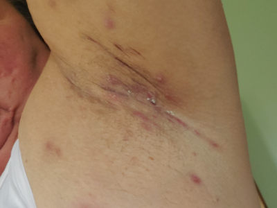 HS small bumps in the armpit.