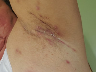 Painful Boils Under Armpits!Could it be Hidradenitis