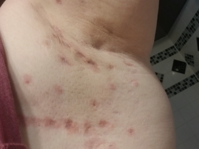 Red bumps may be inflammatory skin condition Hidradenitis suppurative