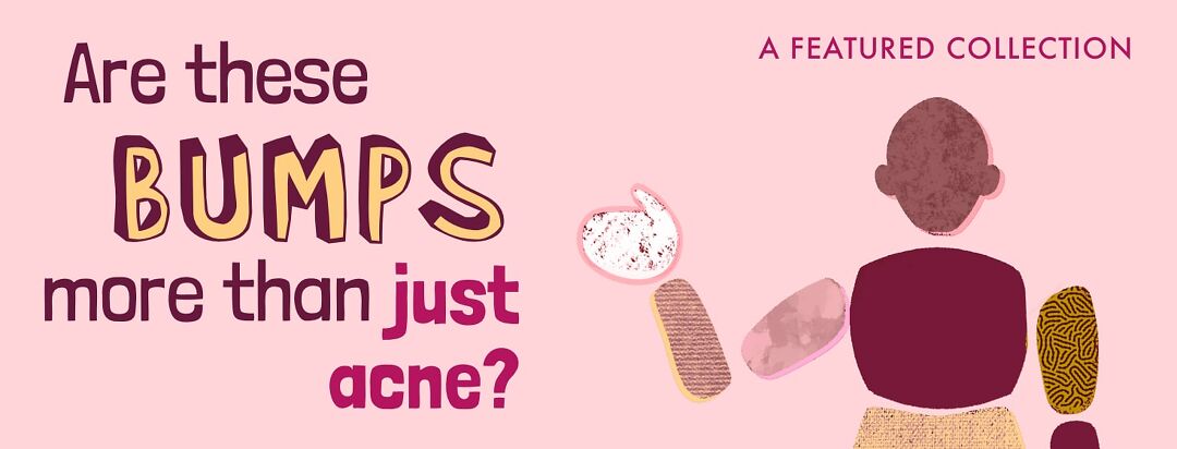 So You Think You Have HS? image